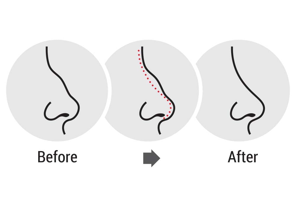 Diagram about nose shapes