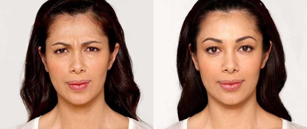 Before and after, Image courtesy of BOTOX® Cosmetic