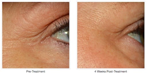 Before and after Alastin Treatment