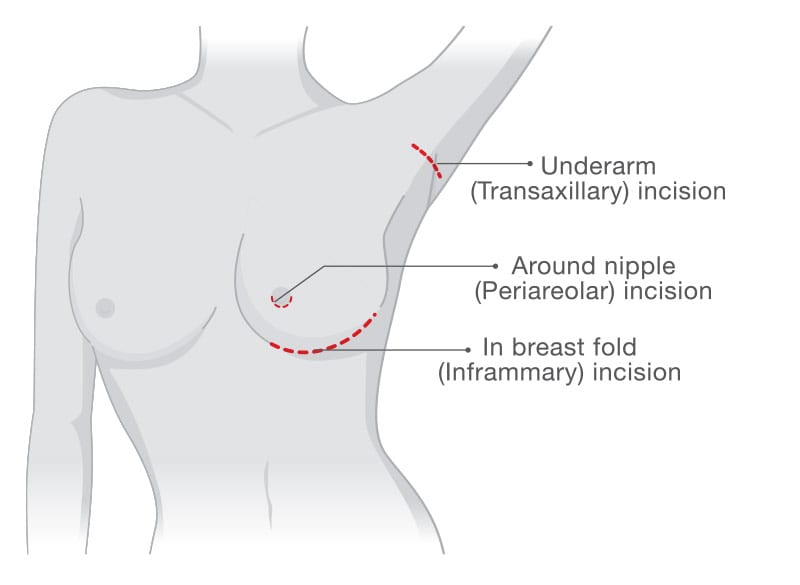 Breastfeeding after periareolar breast augmentation